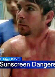 Sunscreen Burns